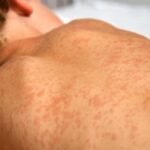 Measles outbreak expected to continue in northeast B.C., health officials say
